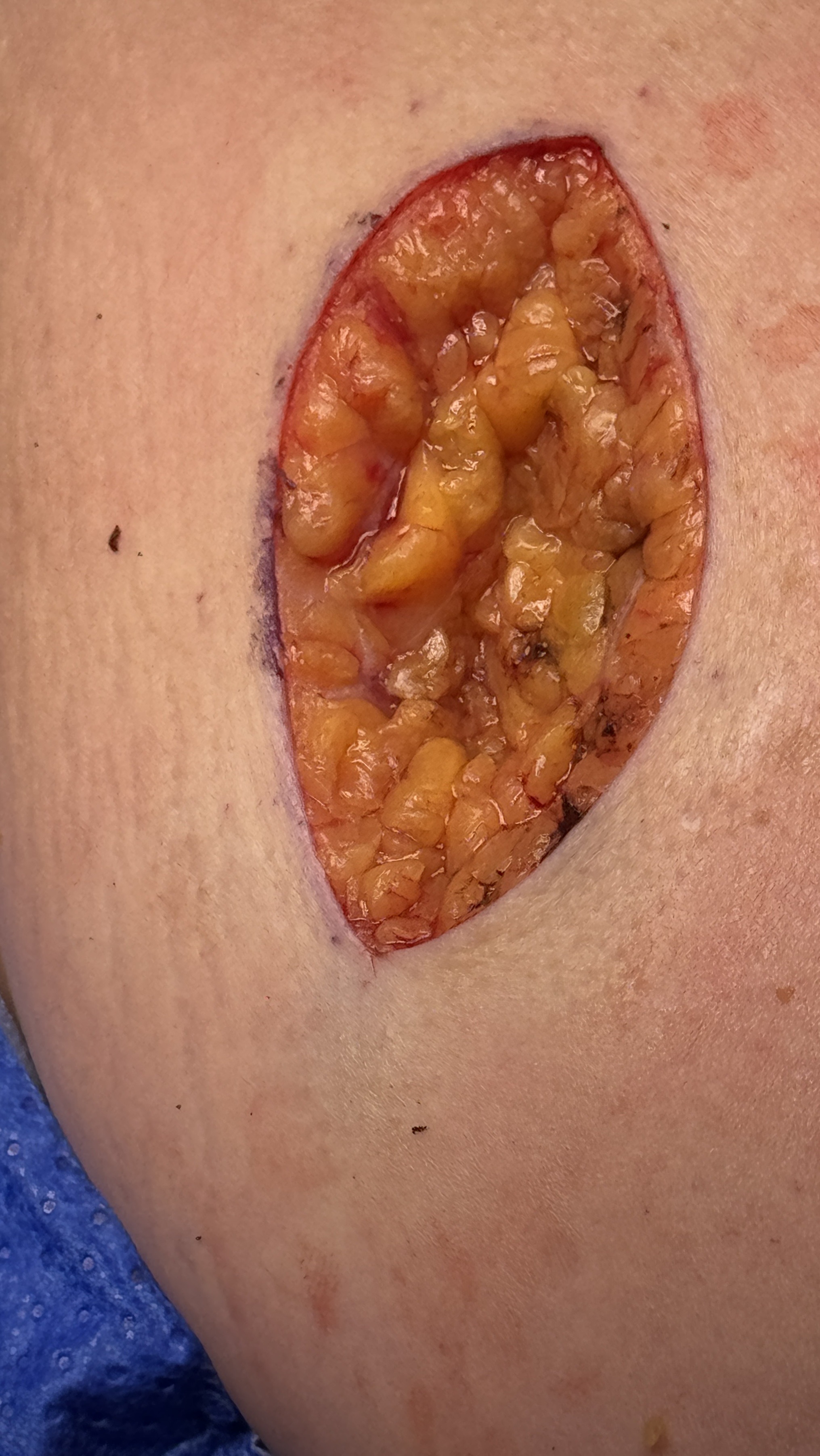 Skin cancer excision example used to illustrate surgical/gross lesion management